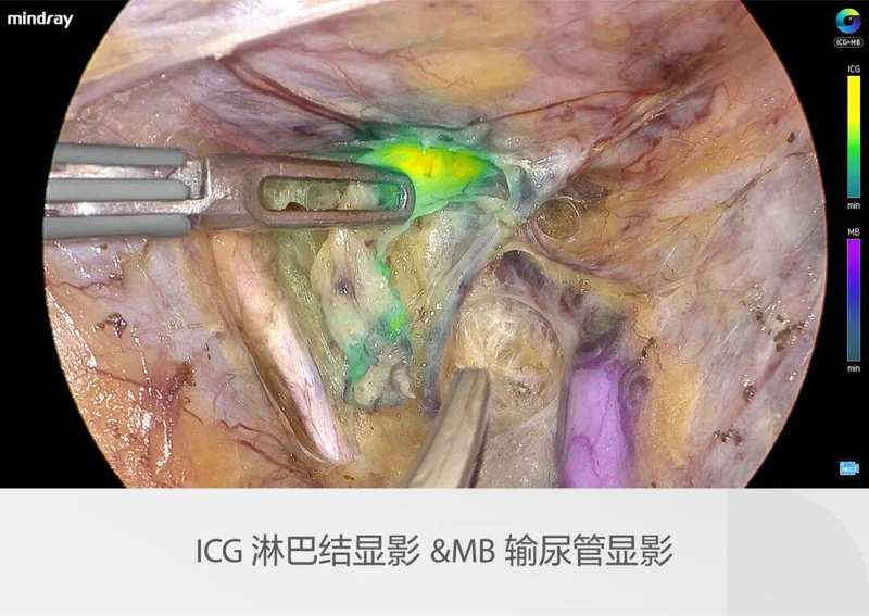 迈瑞全域荧光智能影像平台,探索精准外科未达之“镜” 新闻 迈瑞全域荧光智能影像平台,探索精准外科未达之“镜” 新闻 迈瑞全域荧光智能影像平台,探索精准外科未达之“镜” 新闻