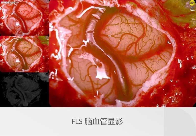 迈瑞全域荧光智能影像平台,探索精准外科未达之“镜” 新闻 迈瑞全域荧光智能影像平台,探索精准外科未达之“镜” 新闻 迈瑞全域荧光智能影像平台,探索精准外科未达之“镜” 新闻