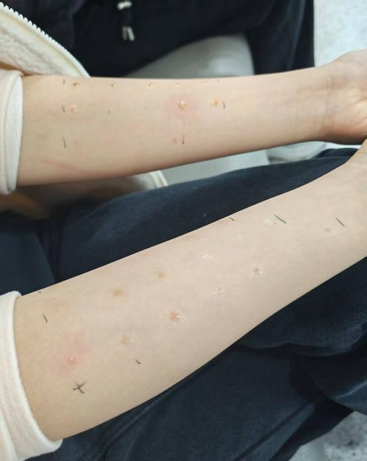  《被花粉“狙击”的春天：那些突然过敏的人，经历了什么？》 健康养生